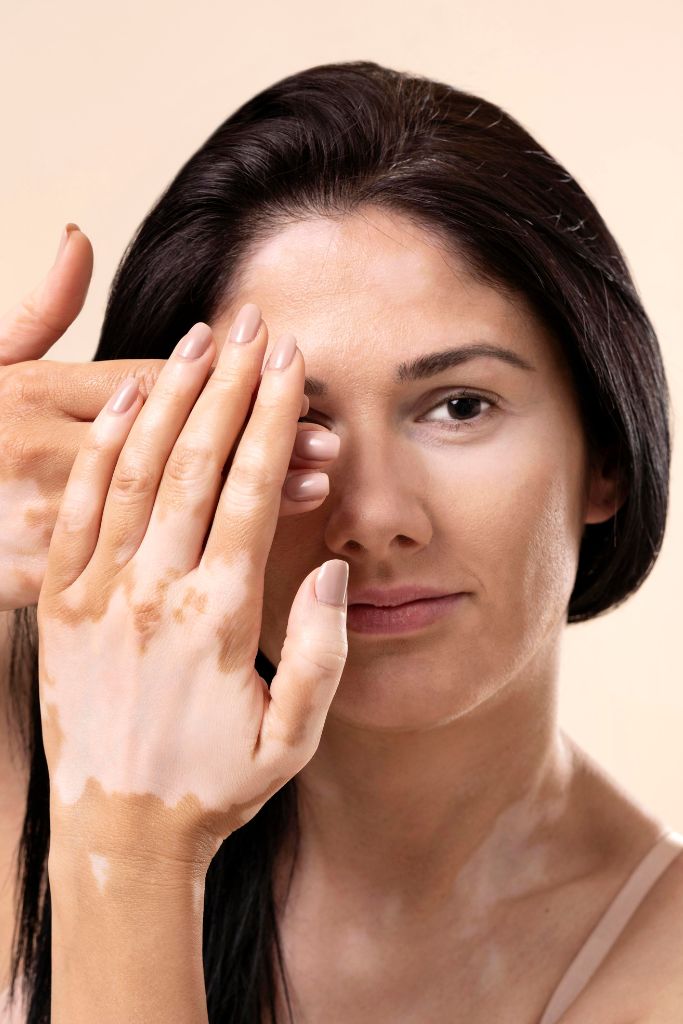 Vitiligo Laser Treatment in Kondhwa & NIBM | Dr. Seema Hashmi