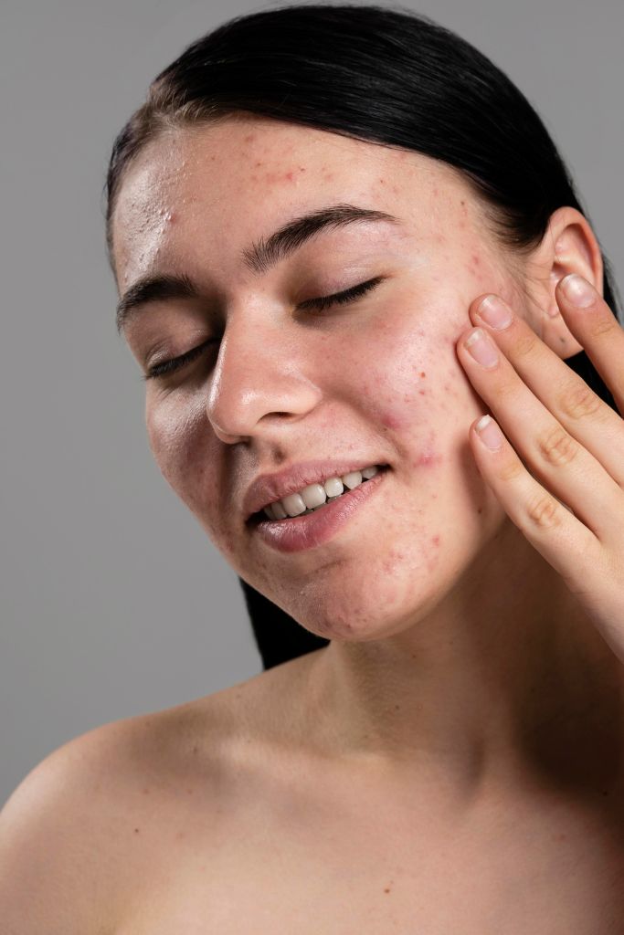 Effective Pimple Treatment in Kondhwa & NIBM with Dr. Seema Hashmi