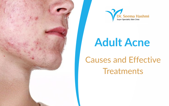 What Causes Adult Acne & How to Treat It Effectively
