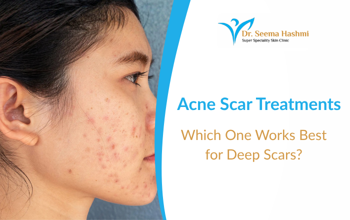 Acne Scar Treatments: Which One Works Best for Deep Scars?