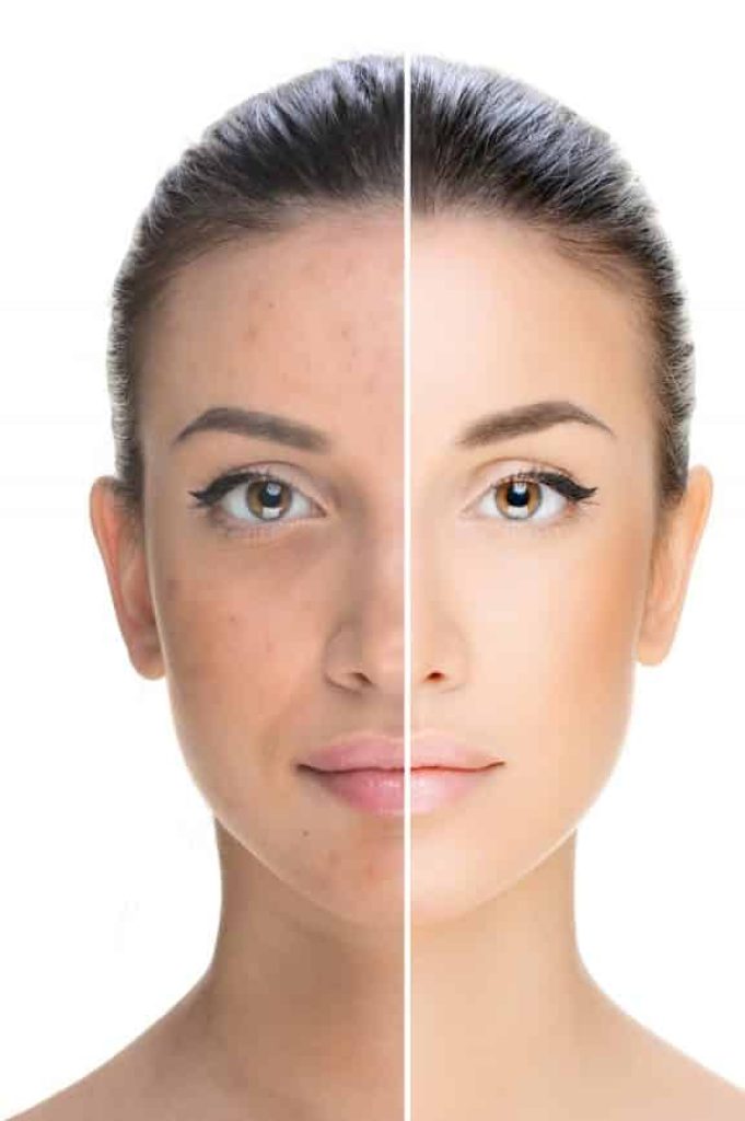 Skin Pigmentation Treatment in Kondhwa & NIBM, Pune